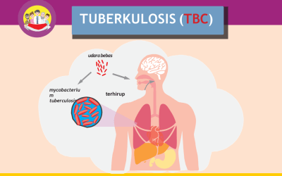 Yabhysa Peduli TBC Sumenep Gencarkan Pemberian TPT